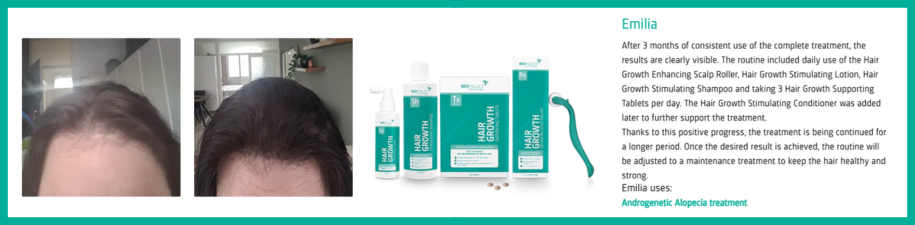 Neofollics - Alopecia